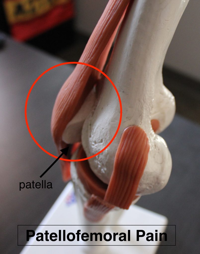 Patellofemoral Pain